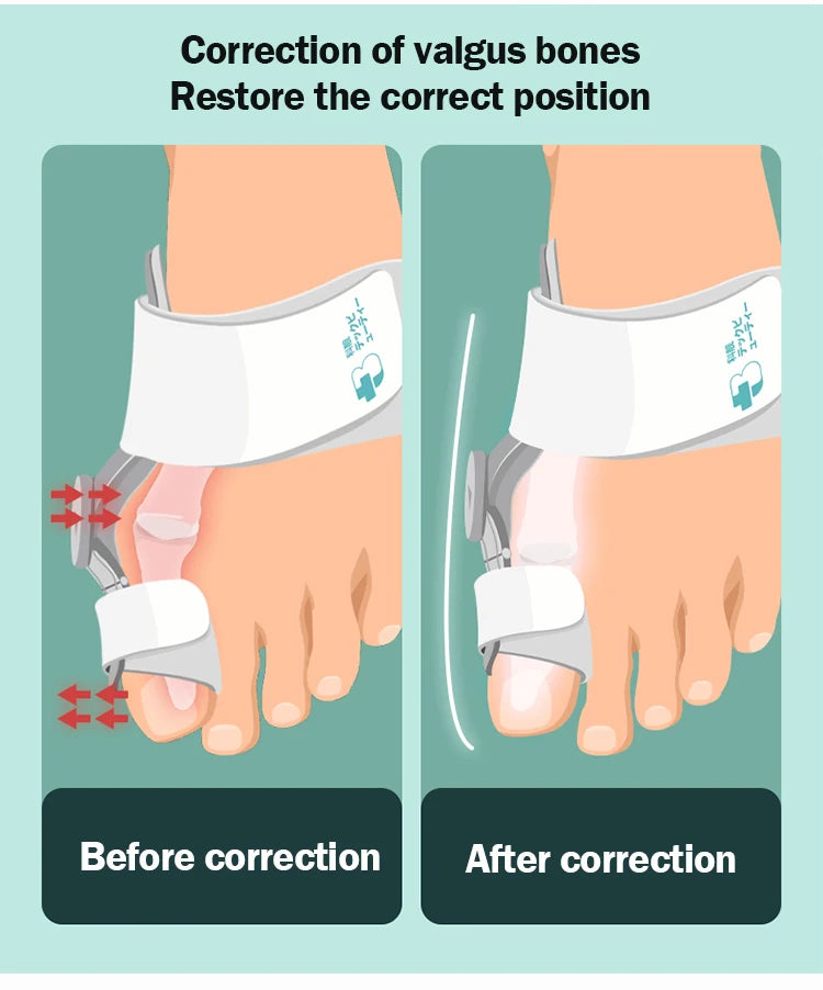 Hallux Valgus Correction Bunion Splint – All-Day Pain Relief & Toe Alignment Support